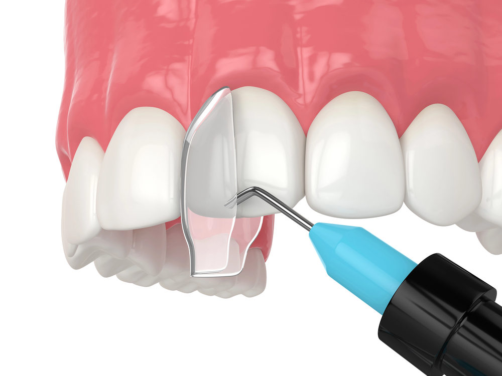 cosmetic bonding raleigh nc